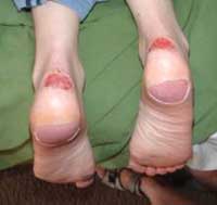 An example of significant blisters